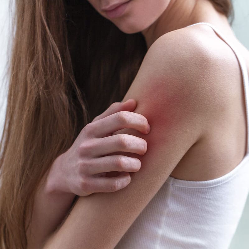 tratamiento-para-urticaria-alergia-e-inmunologia-en-cdmx